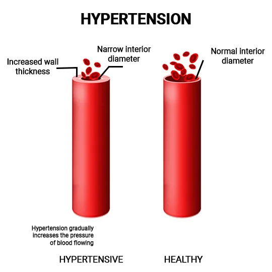 Does exercise raise blood shop pressure