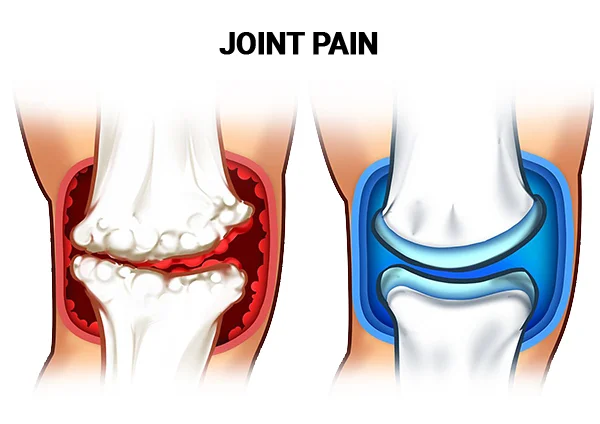 Is it a Sprain, Strain, or Tear? - New York Bone & Joint Specialists